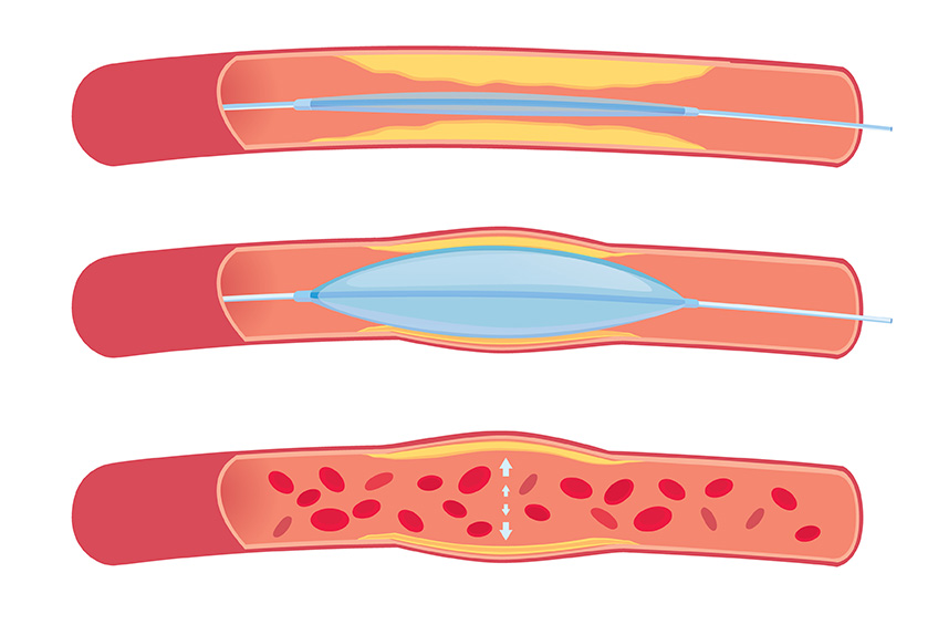 technique angioplastie