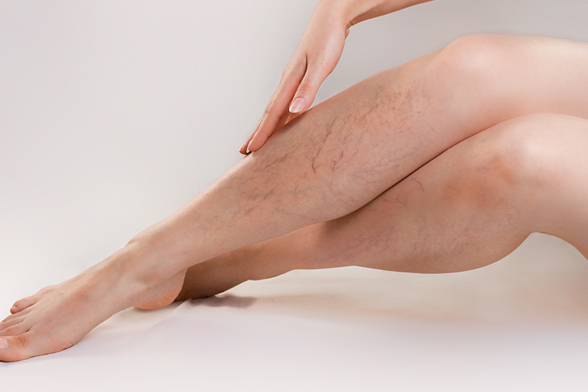 Varices