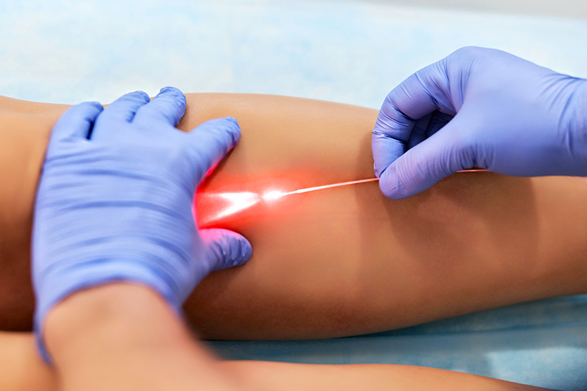 laser endoveineux