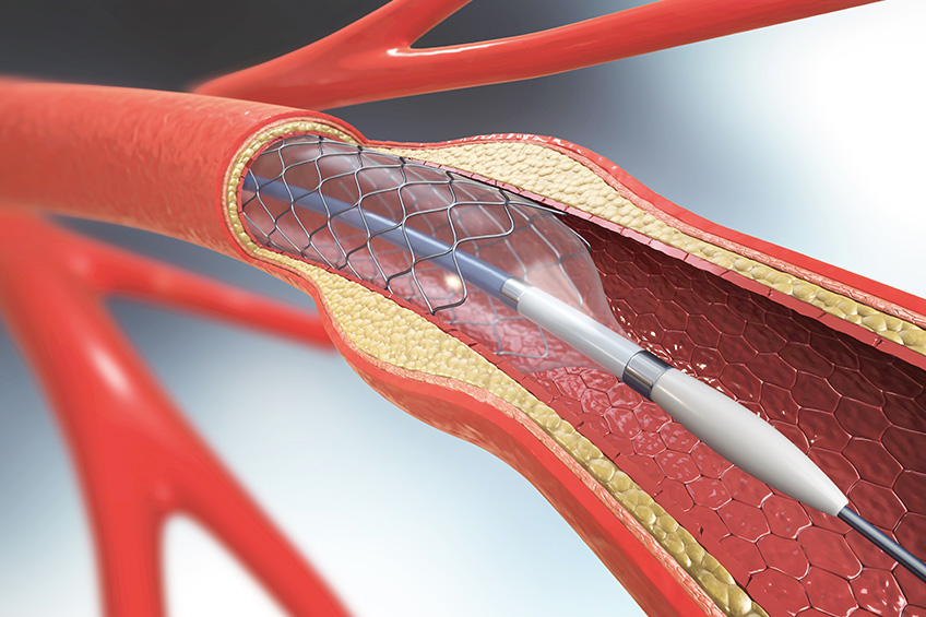 angioplastie